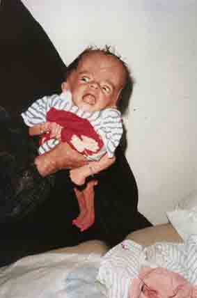 Photograph of deformed baby