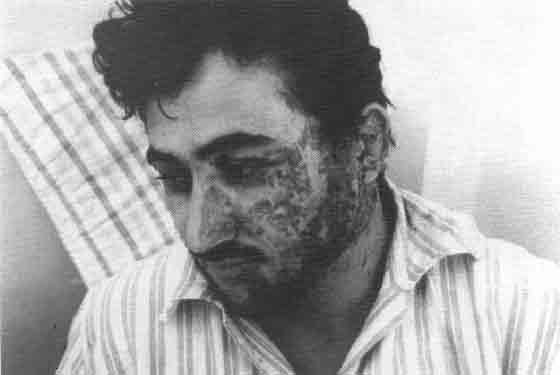 Photo of a severley disfigured Iraqi soldier